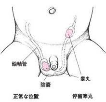 停留睾丸